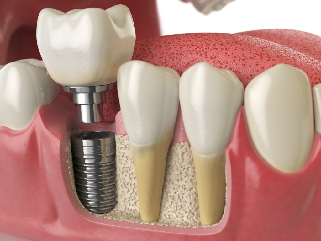 tooth dental implant 