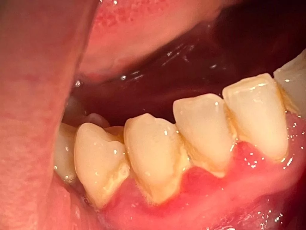 periodontitis treatment at home