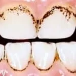 Why does my tooth still hurt after dentist recently filled my tooth? causes of tooth pain after filling.