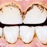 Awareness about Oral Ulcers and Oral Mucosal Lesions