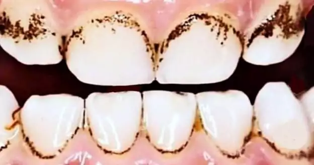 black spot between teeth