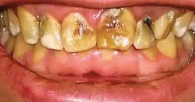 what causes black spots on teeth