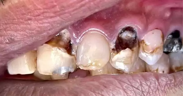 black spots on tooth