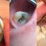 Periodontitis at Home Care 2024: How Do I Know If I Have Gum Disease?