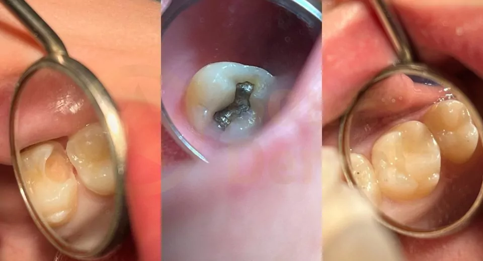 types of cavity fillings