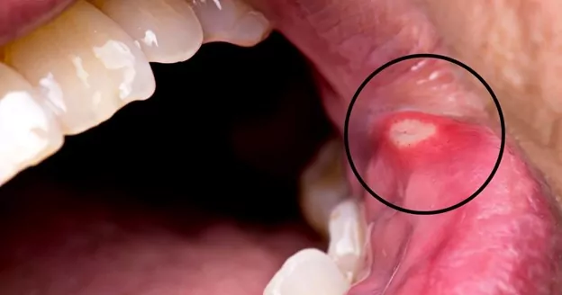 oral mucosal lesions