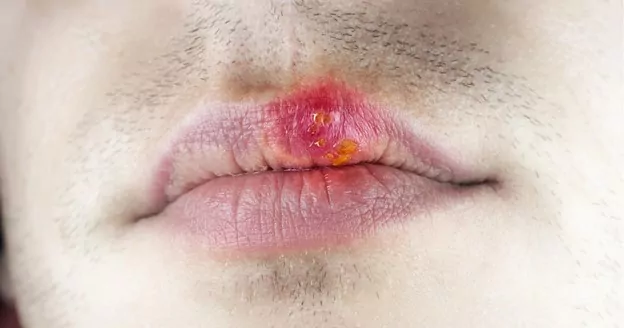 oral mucosal lesions pictures