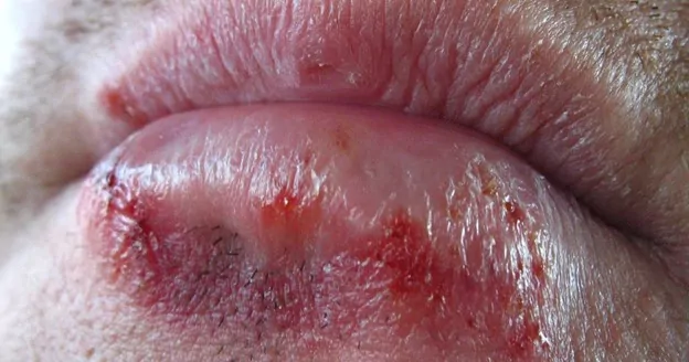 oral mucosal lesions pictures