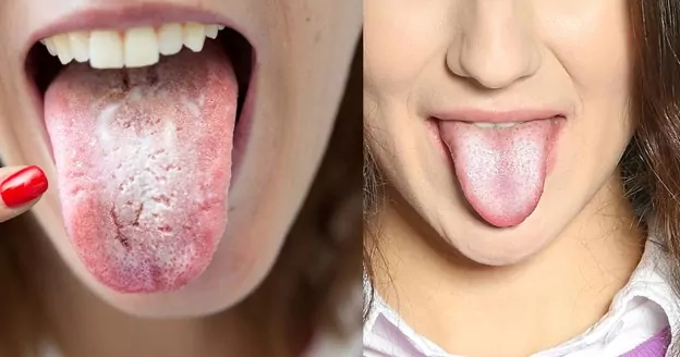 oral mucosal lesions pictures