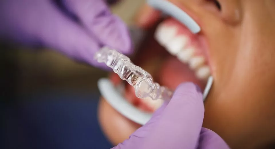 Invisalign Braces