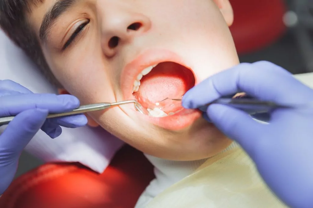 Dentist dental fillings
